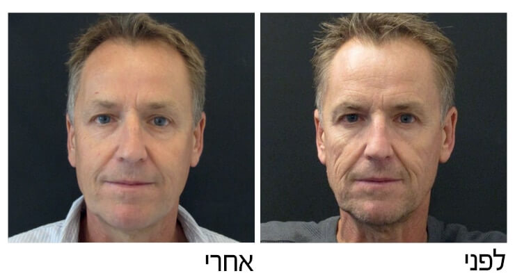 סקולפטרה לפני אחרי (3)