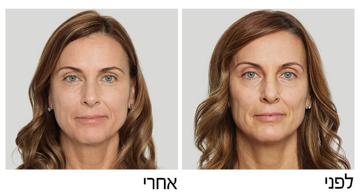 סקולפטרה לפני אחרי (4)