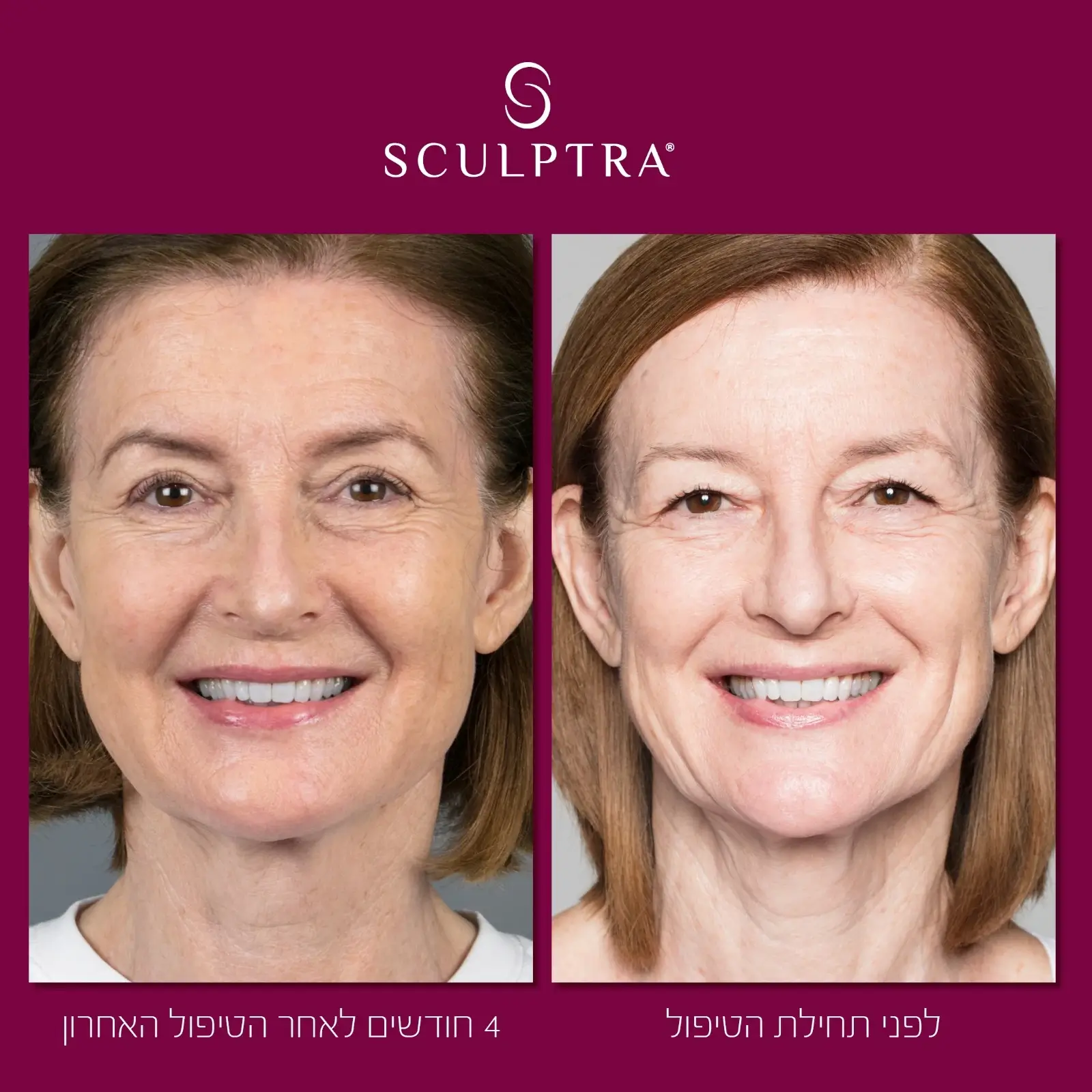 סקולפטרה לפני אחרי.webp